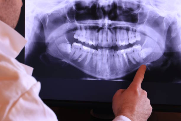 Best Emergency Treatment for Dental Infections or Abscesses in Thousand Palms, CA
