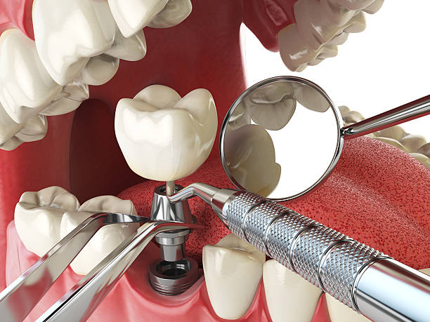 Best Urgent Care for Lost Fillings or Crowns in Thousand Palms, CA